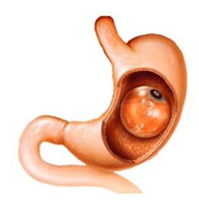 ballon gastrique toulon