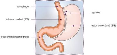 Chirurgie sleeve gastrectomie la seyne sur mer